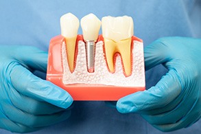 A dental implant model