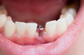 Closeup of an integrated dental implant in Salinas