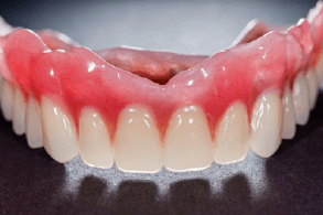 A complete upper denture.