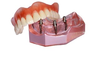 Model of denture and dental implants in Salinas.