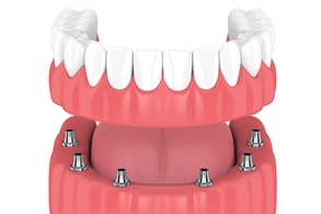 Dental model of an implant-retained denture.