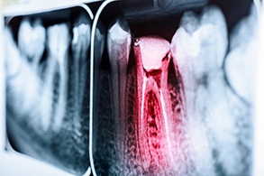 Highlighted X-ray of a toothache in Salinas 