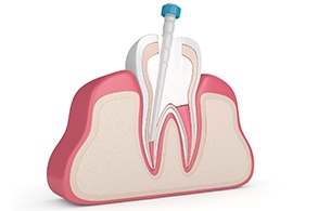 Digital illustration of root canal therapy in Salinas