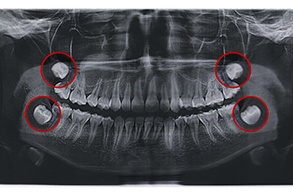 X-ray with wisdom teeth in Salinas, CA highlighted