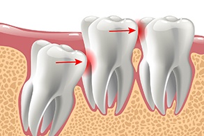 Illustration of impacted wisdom tooth before wisdom tooth extraction in Salinas, CA