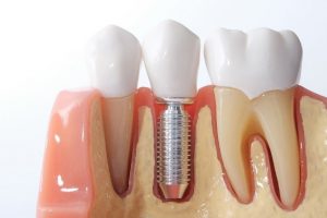 Representation of dental implant