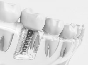 diagram of dental implant inside the jaw