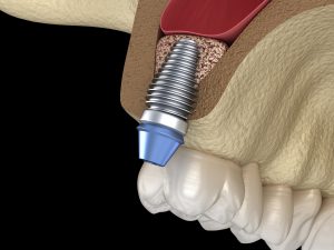 dental implants