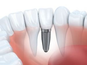 A dental implant on the front tooth