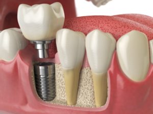 dental implant 3D illustration